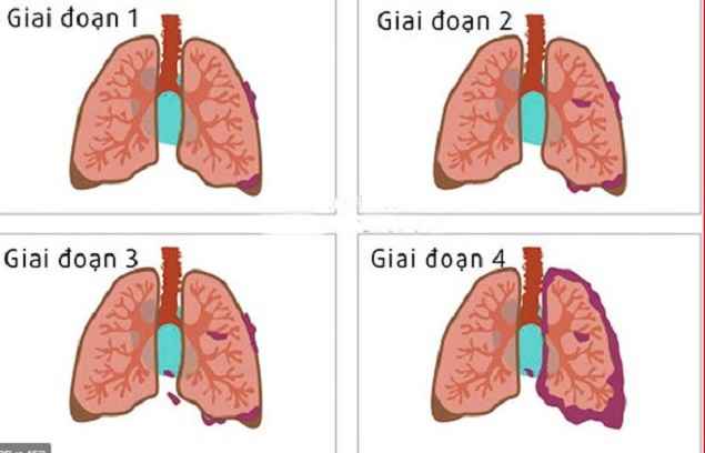 Ung thư phổi là gì? 9 dấu hiệu ung thư phổi giai đoạn đầu.