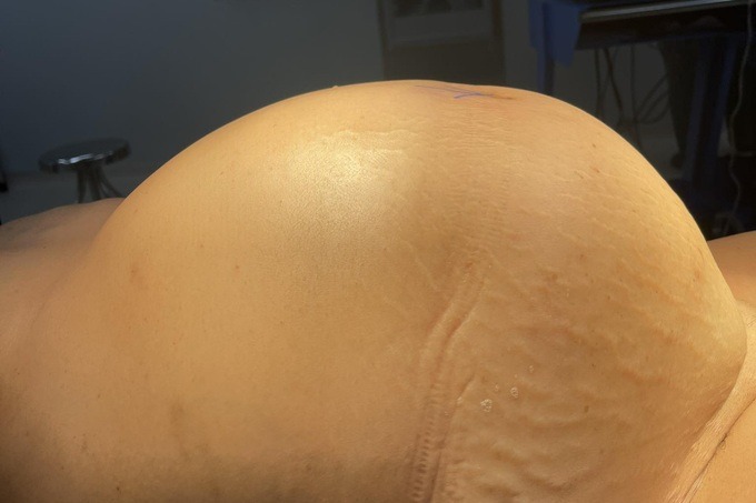 SỐC: Người phụ nữ mang khối u buồng trứng 15kg